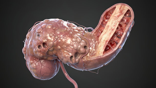 Polycystic kidney disease 3D medical illustration, damaged human kidney with multiple cysts cross‑section view
