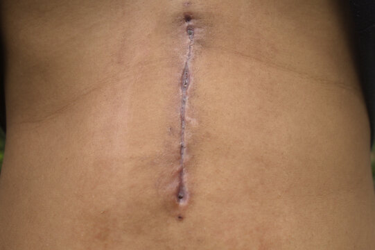 Close-up of a healing abdominal surgical scar 25 days after gallbladder removal surgery, illustrating postoperative recovery, incision healing, medical care, and abdominal surgery.