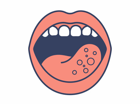 Open Human Mouth Illustration with Spots on Tongue Representing Medical Infection