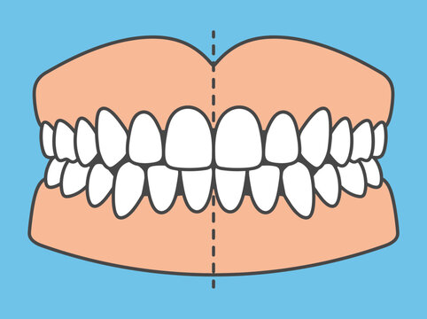 Dental Midline Alignment Illustration - Orthodontic Teeth Diagram
