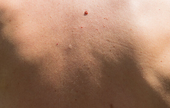 Close-up texture of human skin on the back with moles and fine hairs