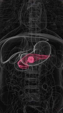 Pancreatic cancer is a malignant tumor that develops in the pancreas, an organ involved in digestion and blood sugar regulation in Vertical Video UHD