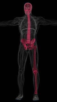 Polyostotic Paget's disease of bone is a chronic skeletal disorder affecting multiple bones, characterized by abnormal bone remodeling that can lead to enlarged, weakened, or misshapen bones in UHD