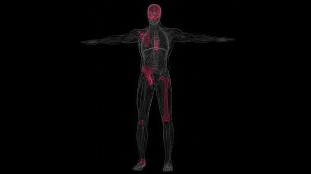 Polyostotic Paget's disease of bone is a chronic skeletal disorder affecting multiple bones, characterized by abnormal bone remodeling that can lead to enlarged, weakened, or misshapen bones in 4K UHD