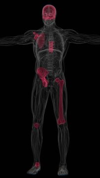 Polyostotic Paget's disease of bone is a chronic skeletal disorder affecting multiple bones, characterized by abnormal bone remodeling that can lead to enlarged, weakened, or misshapen bones in UHD
