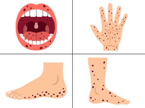 Medical Illustration of Hand, Foot, and Mouth Disease Symptoms