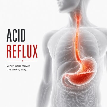 Medical Illustration of Acid Reflux and GERD showing Gastric Acid Moving Up the Esophagus