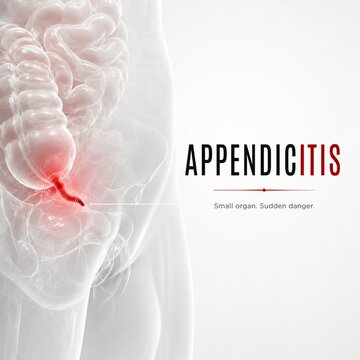 3D Medical Illustration of Appendicitis Inflammation in the Human Digestive System
