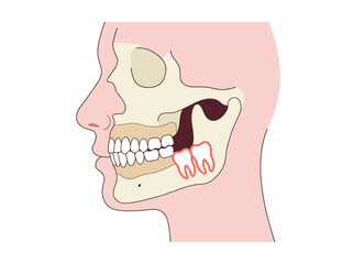 Medical Illustration of Impacted Wisdom Teeth in Human Jaw © Tezar