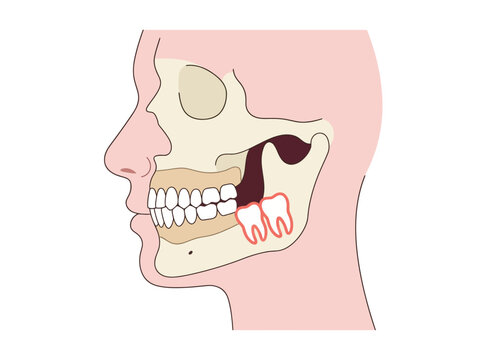 Medical Illustration of Impacted Wisdom Teeth in Human Jaw