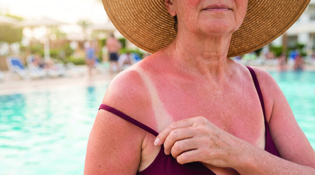 Heatstroke prevention helps sunburned woman protect shoulder beside swimming pool. heat wave hot weather temperature. heat stroke dehydration symptom risk, emergency warning protection aid