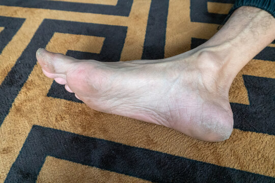 A person's feet and lower legs resting on a patterned surface, showing prominent, clearly visible superficial blood vessels on the dorsum of the foot and around the ankle. 