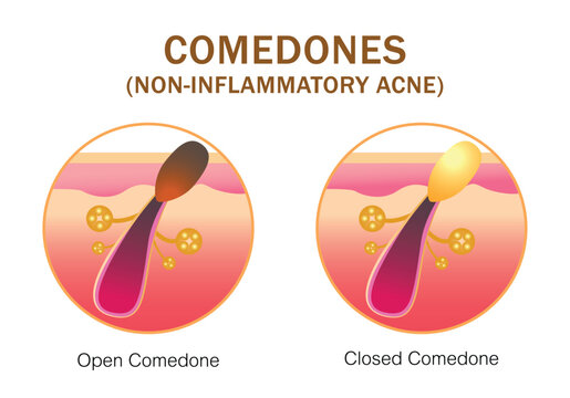 Acne,stages of development,healthy skin,vector design