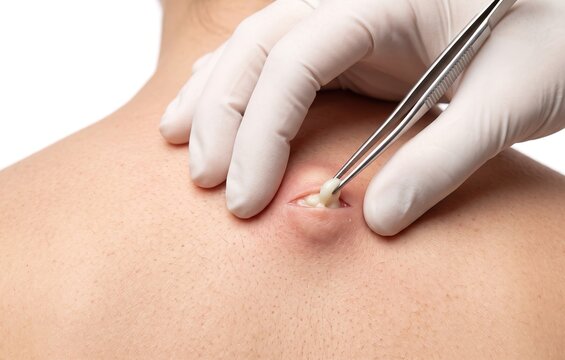 Surgical extraction of a sebaceous cyst or lipoma from patient back, dermatologist using tweezers to remove pus