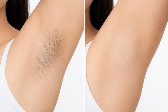 Underarm hair removal before and after comparison