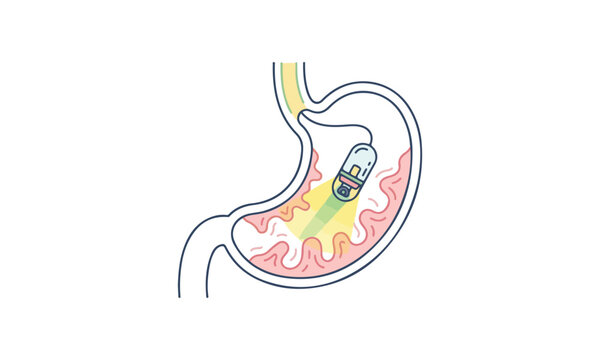 Capsule endoscopy procedure illustration showing a camera pill inside a human stomach scanning the internal lining on white background.