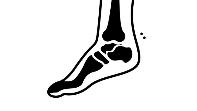 lower leg fracture animated video, orthopedic foot injury motion graphics, broken ankle bone animation,