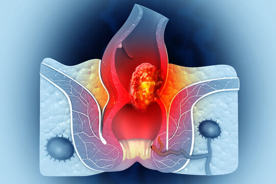 Colon cancer. Cancer attacking cell. Colon disease concept. 3d illustration