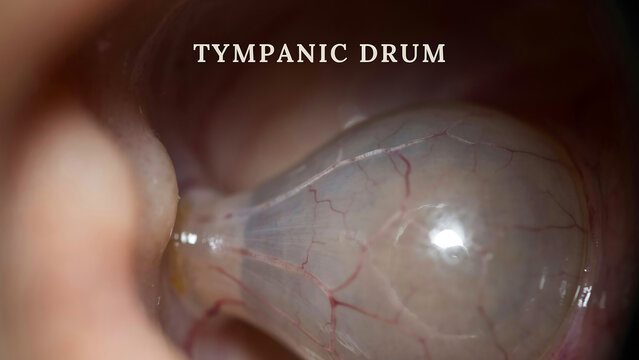 Medical examination of human ear showing healthy tympanic membrane drum