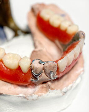 Close-up of removable partial denture on plaster mold