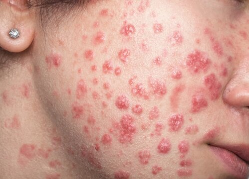Closeup of a persons cheek with numerous red inflamed acne lesions and pustules covering the skin