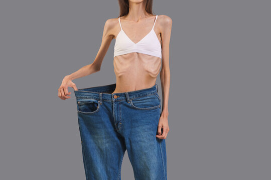A very slender young woman loses so much weight that her trousers are too big.