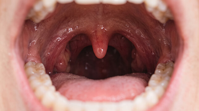 Close Up View Of Open Human Mouth Showing Uvula Tonsils And Oral Cavity During Medical Examination. Concept of throat, human throat, medical exam, anatomy, palate, tongue, dentist.