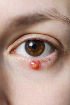 Close-up of a human eye with a red inflamed bump on the lower eyelid, illustrating eye care, irritation, infection, ophthalmology and health