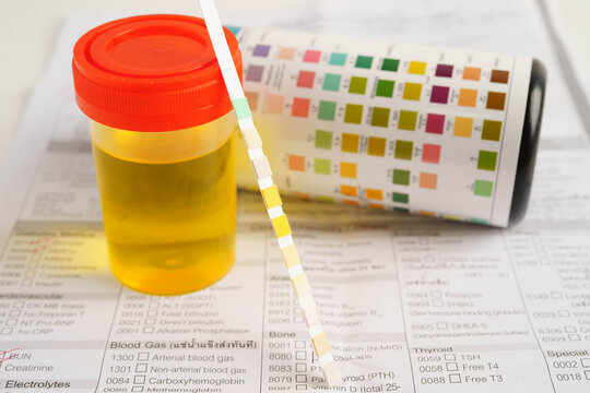 Urinalysis, urine cup for check health examination in laboratory.