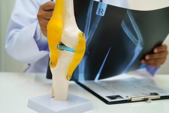 Doctor examining knee joint bone radiography xray film.