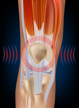 Medical vector illustration of knee pain showing an external view of the painful knee and an anatomical view of the knee joint with patella, bones, muscles, tendons and ligaments. 