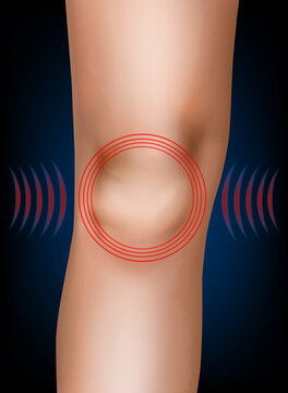 Knee Pain and Patella Anatomy Medical Vector Illustration with Pain Highlight. Painful Knee Joint and Kneecap Anatomy with Red Pain Indicator Medical Illustration