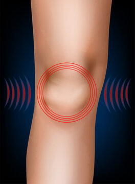 Knee Pain and Patella Anatomy Medical Vector Illustration with Pain Highlight. Painful Knee Joint and Kneecap Anatomy with Red Pain Indicator Medical Illustration