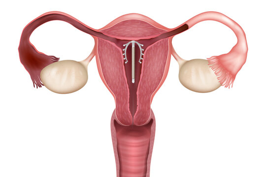 IUD in Uterus Female Reproductive Anatomy and Contraception Medical Vector Illustration. Intrauterine Device Placement in Uterus for Birth Control. Copper IUD Contraception Inside Uterus with Ovaries 