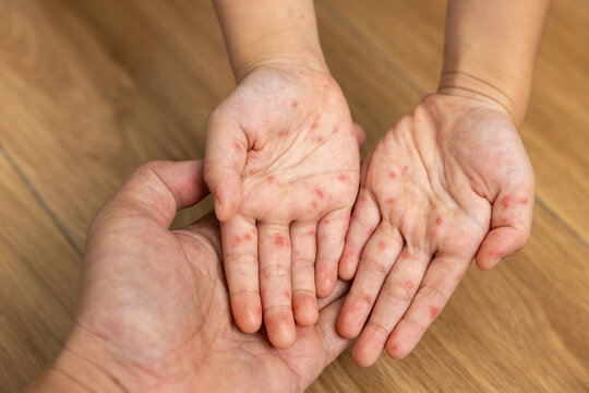 Sick child with hand foot and mouth disease showing red rash and skin lesions on the hands and feet, with a caregiver examining the symptoms and providing home care.