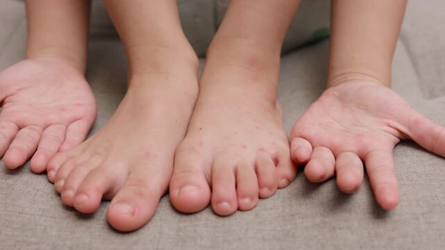 Child with hand foot and mouth disease showing red rashes on hands and feet