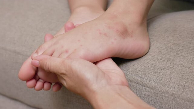 Child with hand foot and mouth disease showing red rashes on hands and feet