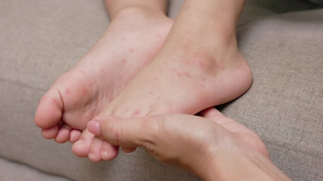 A sick child with hand foot and mouth disease showing red rash and skin lesions on the hands and feet, with a caregiver examining the symptoms and providing home care.
