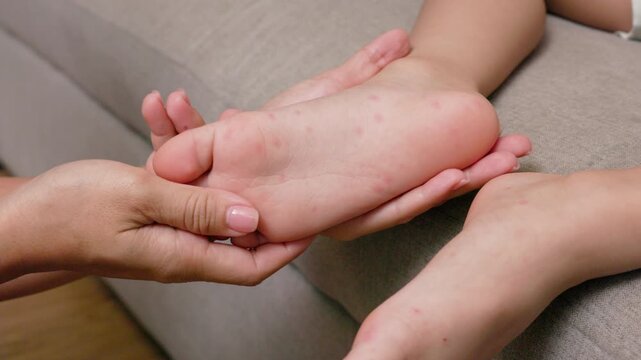 A sick child with hand foot and mouth disease showing red rash and skin lesions on the hands and feet, with a caregiver examining the symptoms and providing home care.