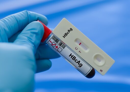 Blood sample tube for HBcAg test analysis.