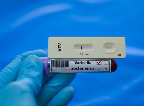 Blood sample of patient negative result for varicella zoster virus.