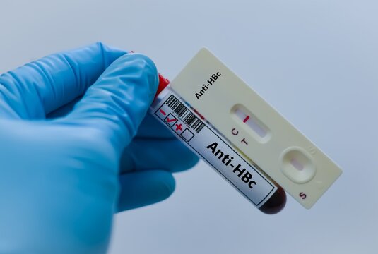 Blood sample tube of patient negative result for anti-HBc.