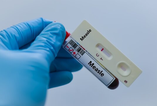 Blood sample of patient negative result for measle virus.