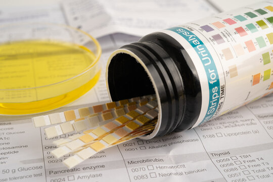 Urinalysis, urine cup with reagent strip pH paper test and comparison chart in laboratory.