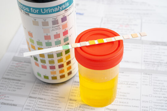 Urinalysis, urine cup with reagent strip pH paper test and comparison chart in laboratory.