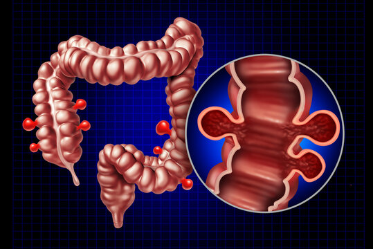 Diverticulosis Disease With Colonic Diverticula  and Symptomatic Diverticular illness with colonic diverticula as small pouch like protrusions that form in the wall of the colon resulting in Abdominal