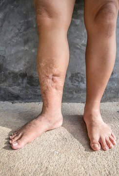 Skin lesions resulting from accidents.