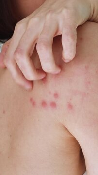 A woman scratches her shoulder bitten by a bedbug on a white background, close-up. Skin health problem. Red pimples.	