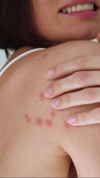 A woman scratches her shoulder bitten by a bedbug on a white background, close-up. Skin health problem. Red pimples.	