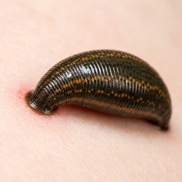 Medical leech attached to human skin feeding during hirudotherapy treatment